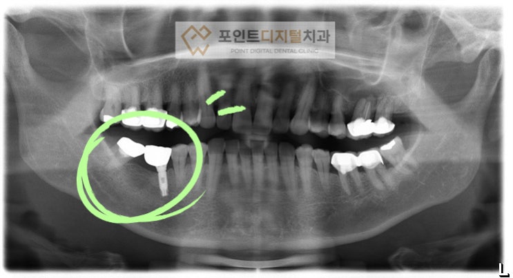  [탕정치과] 임플란트 20년 경과(3i 임플란트) / 천안 아산