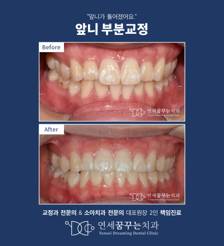 앞니만 간단히 가지런하게 하는 부분교정, 부분교정이 가능한 경우는? 앞니만 간단히 가지런하게 하는 부분교정, 부분교정이 가능한 경우는?