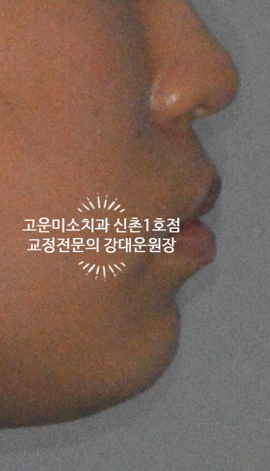  입술돌출을 비발치로 치료한 교정치료증례신촌교정치과 고운미소 신촌1호점 교정전문의강대운원장 증례