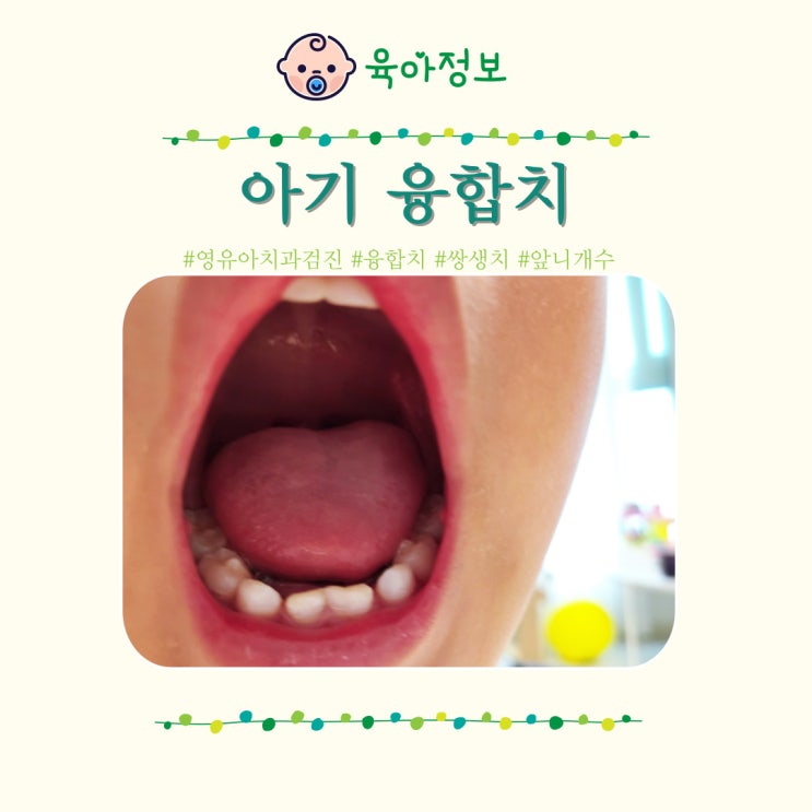  융합치 아기 앞니 개수 벌어짐, 영유아 치과검진