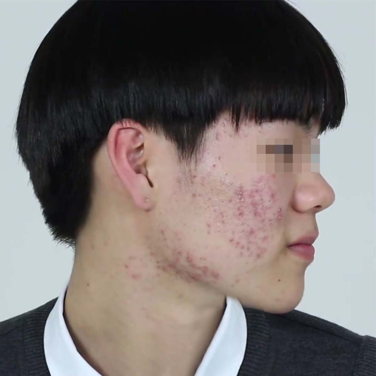 10대 <b>아들</b> 피부트러블 잡은 꿀팁 공유(<b>유재석</b> 화장품!)