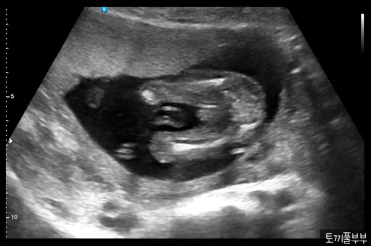[임신일기] 16주~17주 : 2차 기형아 검사 / 산전 정신지체 선별검사 / 토복이 성별