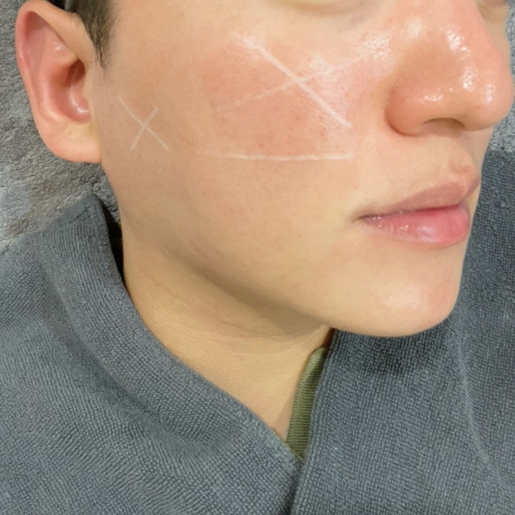 신사역 피부과에서 튠페이스 후기 및 효과 신사역 피부과에서 튠페이스 후기 및 효과