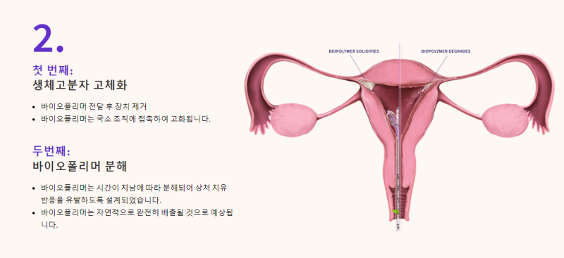 피메이시스(FEMY) 영구 피임의 핵심 임상 시험에 대한 임상시험계획 FDA 승인 발표 (회사소개) Femasys Inc ...