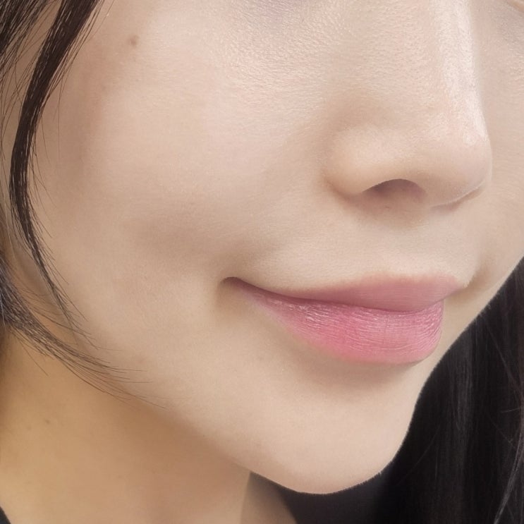  용산 피부과 티타늄 받으러 갔다 쥬베룩 맞고 온 후기 (f.마취, 통증)