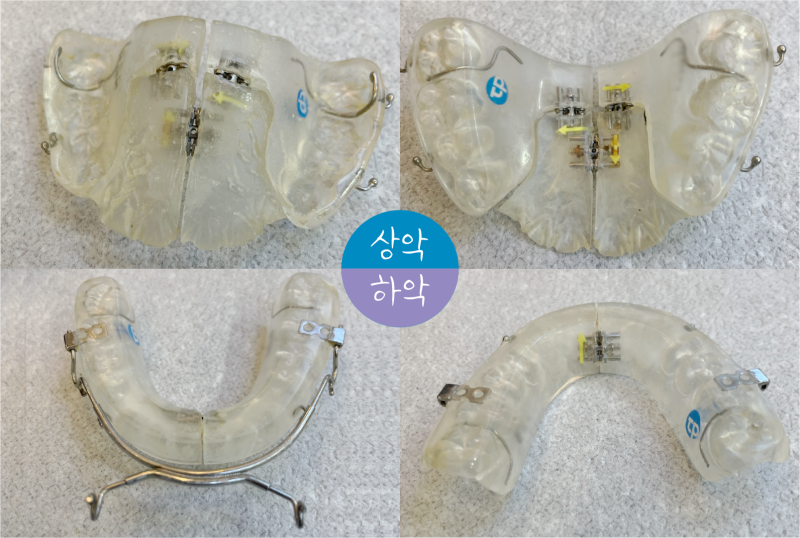턱교정 수술 말고 강남은 비수술 턱교정 방법으로! : 네이버 블로그