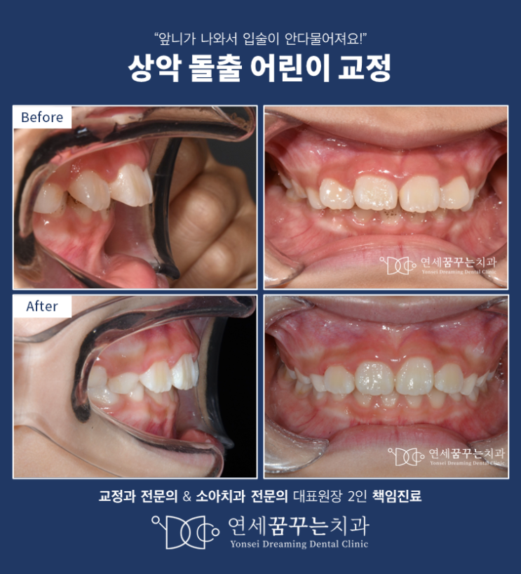 양평 어린이 교정으로 발치 없이 입돌출 해소하기