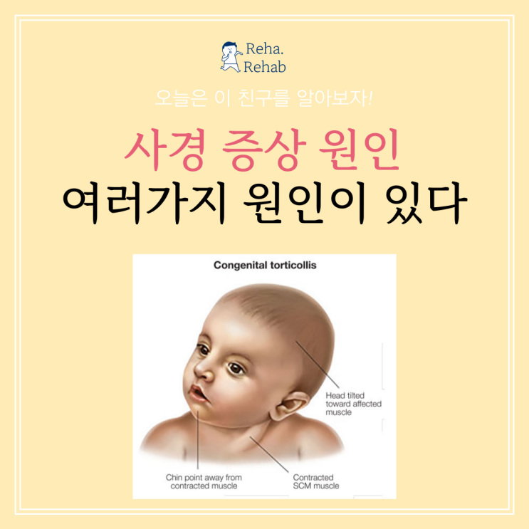  사경 원인, 진단, 그리고 치료법(Torticollis)