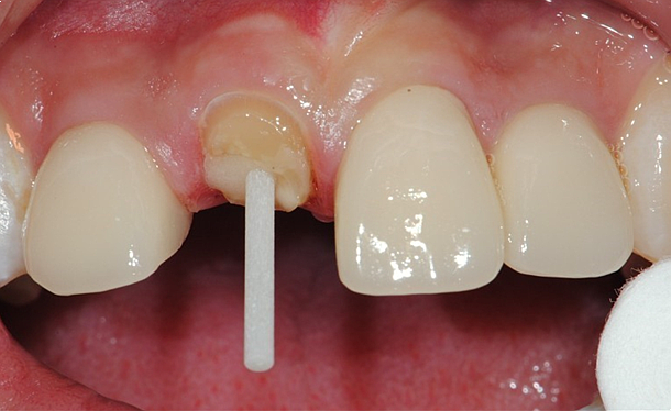 포스트 크라운 치료: 잘 남은 치아에 기둥을 세우고 크라운을 씌우는 치료