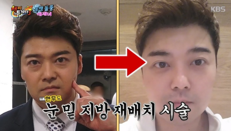 눈밑지방재배치 수술전 체크사항 살펴봐요.