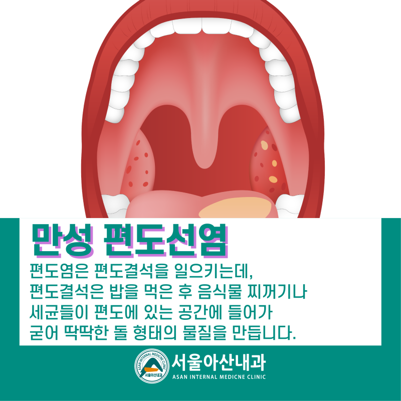 원인미상의 열(열)?->편도염)