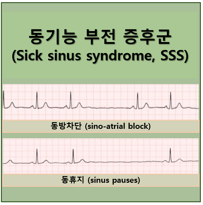동기능 부전 증후군 (Sick sinus syndrome, 의학용어 SSS) 알기 쉬운 총정리