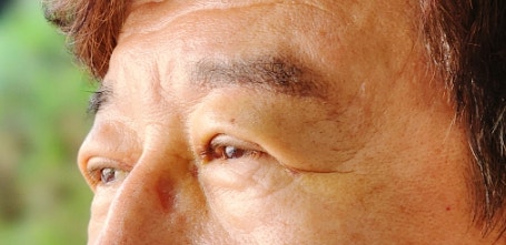  친정아빠 강남역성형외과 꿈꾸는성형외과 눈썹하거상 10일후기