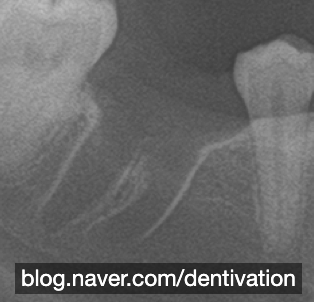 발치를 하고 나면 엑스레이에 어떻게 보일까? 사랑니발치, 치과 X-ray, 치조백선, lamina dura