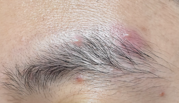  익숙하지 않은 눈썹 여드름 원인과 해결 방법
