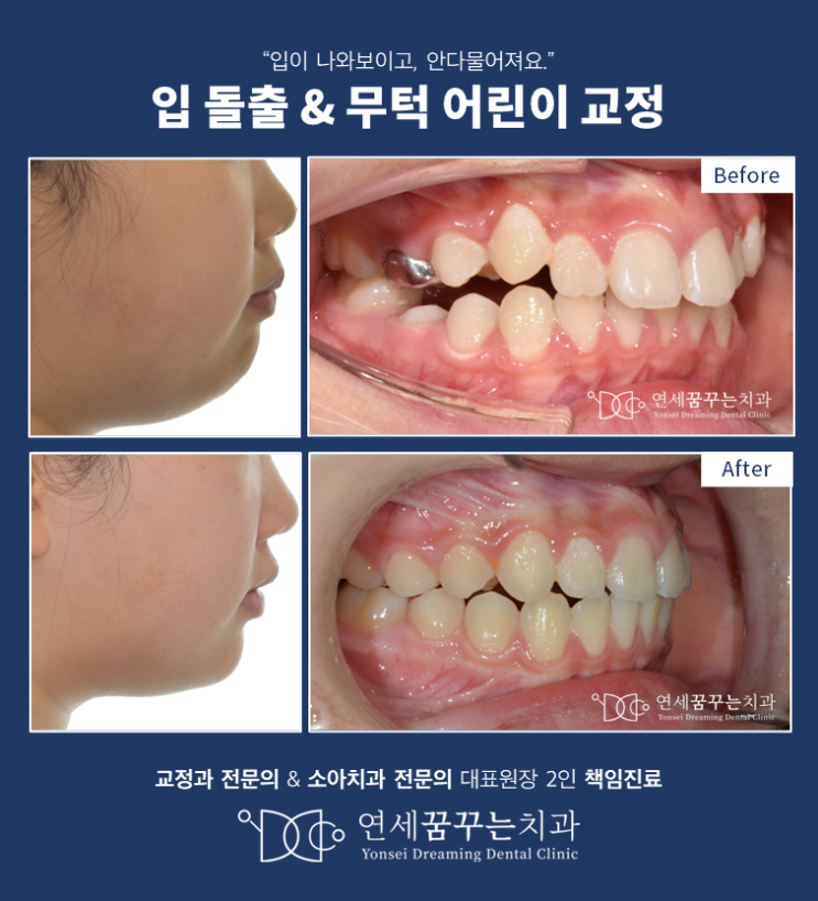 하남에서 발치 없이 어린이 무턱교정으로 돌출 없애기