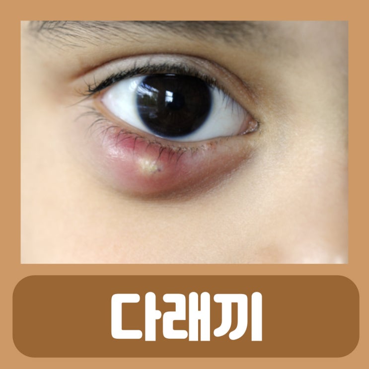  눈속콩다래끼 눈다래끼 콩다래끼 원인 증상 속다래끼 맥립종 겉다래끼 다래끼 전염 초기증상 치료 약 빨리낫는법 안약