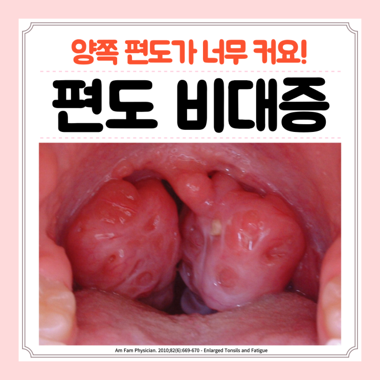  편도 비대증, 편도 비대 비대칭 원인 증상 수술