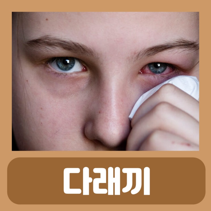  다래끼 약국 약 마로이신 (배농산급탕) 다래끼 나는 이유