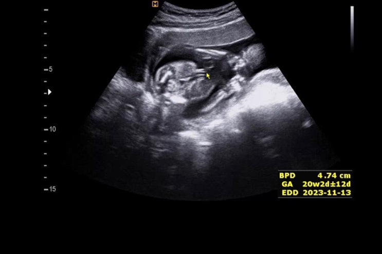 임신 19주 차, 임신 중기 피비침 빨간피 내원