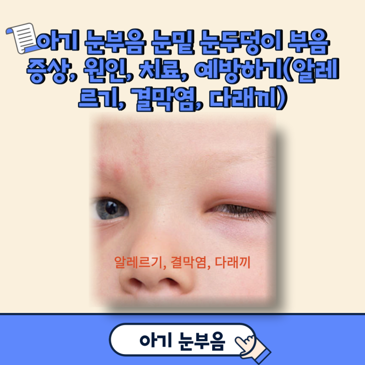 아기 눈부음 눈밑 눈두덩이 부음 증상, 원인, 치료, 예방하기(알레르기, 결막염, 다래끼)