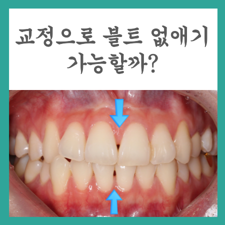  블랙트라이앵글 레진없이 교정만으로 해결한 사례