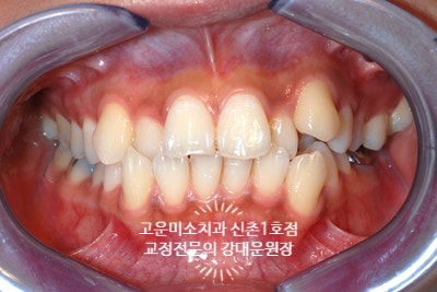  덧니와 약간의 돌출을 동반한 2급 부정교합 발치로 치료증례 신촌교정치과 고운미소 신촌1호점 치료증례