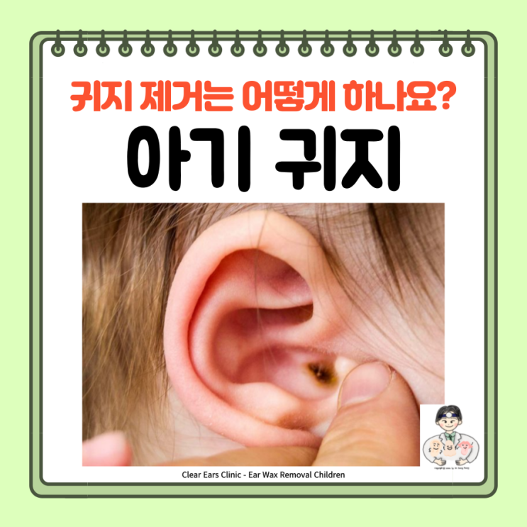  아기 귀지 제거 귀 청소 이비인후과