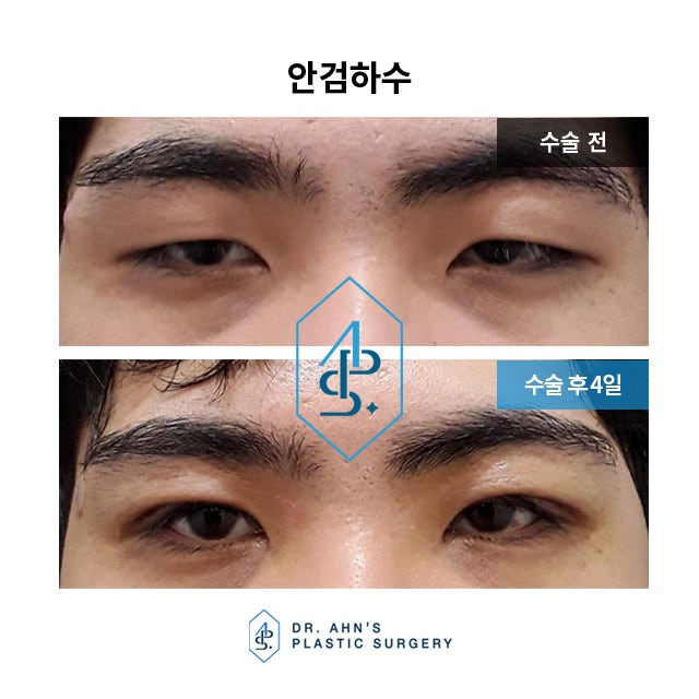 [남자눈성형] 눈꺼풀처림(안검하수) 및 눈매교정 수술사례