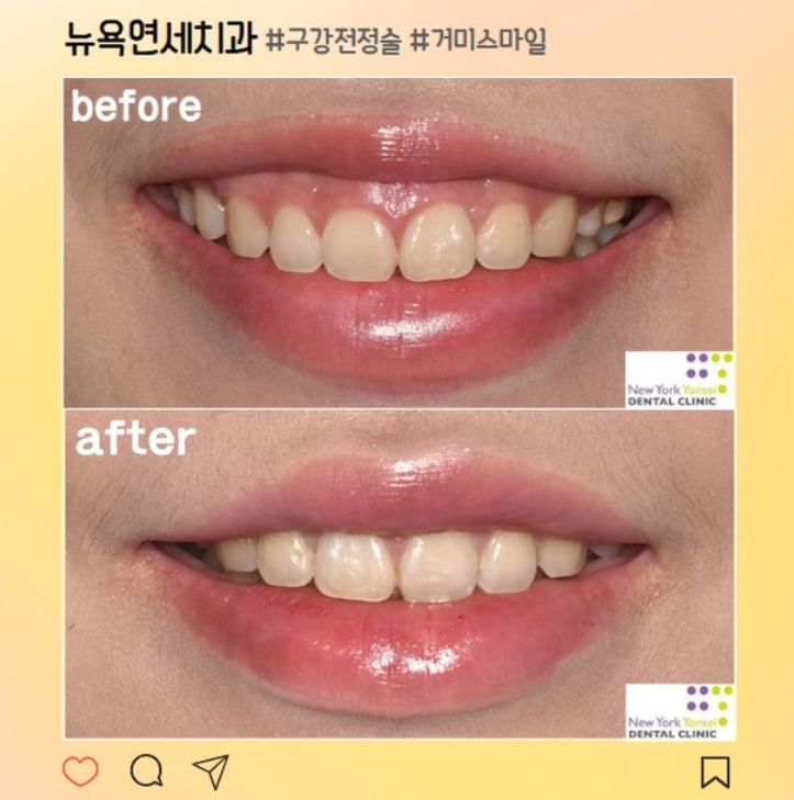  [강남역 치과] 웃을 때 잇몸이 많이 보여 고민인 거미스마일 교정 구강전정술로 해결! (feat. 입술재배치술, lip repositioning)