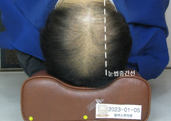  여성 탈모, 초기부터 말기 치료까지 홍대 발머스와 함께 희망을 찾아 갑니다.