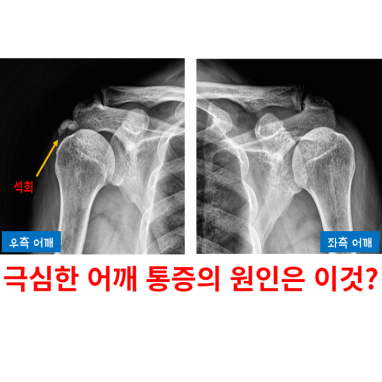  어깨 석회성건염 주사, 갑자기 발생한 통증이 너무 심해요
