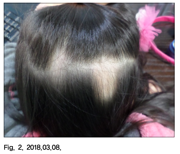 어린이 원형탈모 치료의 어려운 점과 해결책