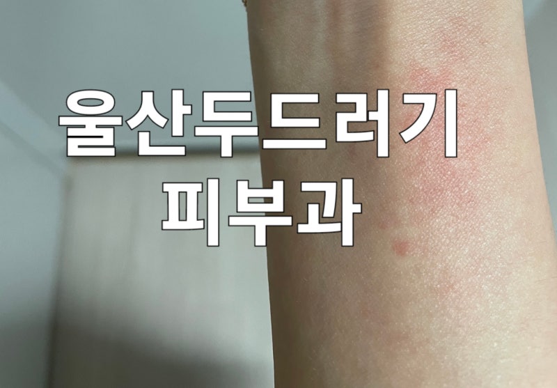 울산두드러기피부과? 약 끊으면 재발하는 분만 보세요