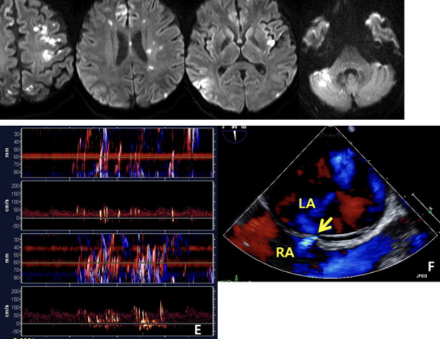 양수색전증 원인 그리고 증상, 위험요인과 예방 등에 대한 이야기 산모와 아이에게 치명적인 임신, 출산 과정의 질환 : 네이버 블로그