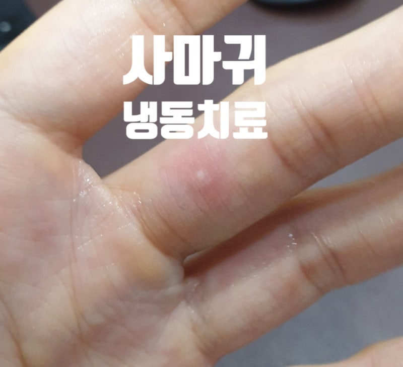 손바닥 손가락 사마귀 피부과 냉동치료