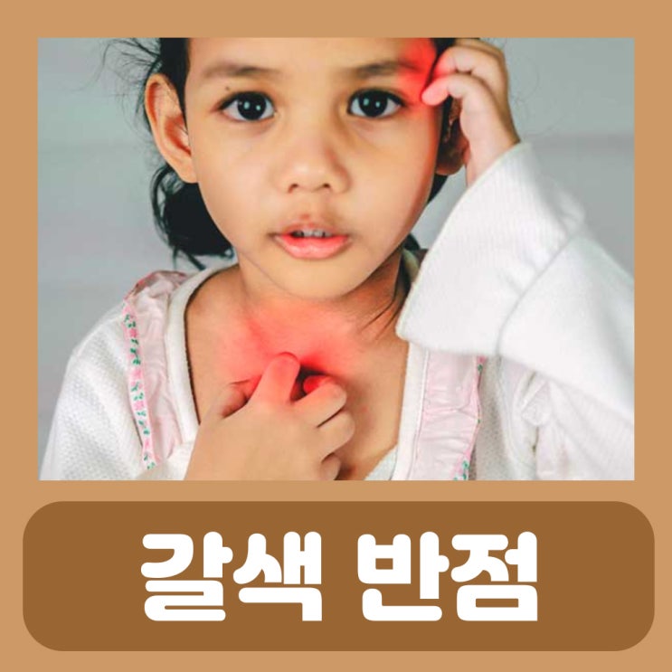  아기 신경섬유종 밀크커피반점 카페오레반점 피부갈색반점