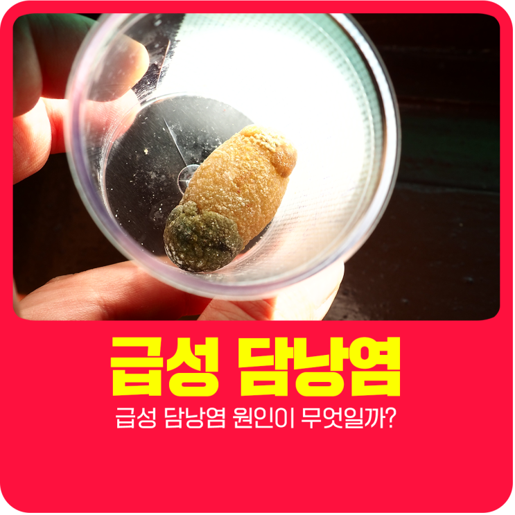  급성 담낭염 원인이 무엇일까?