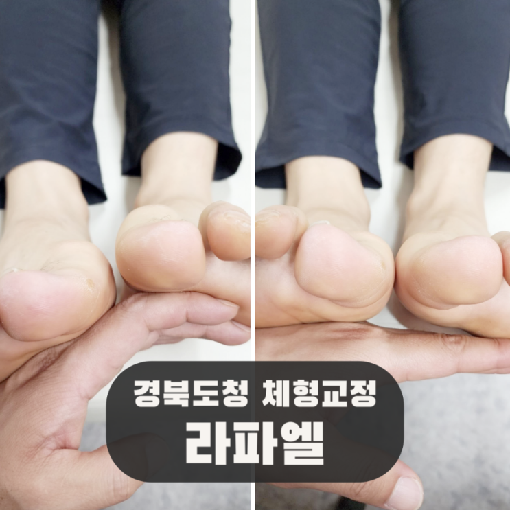  안동 거북목 라파엘 체형교정, 경북도청에서 받는 재활치료