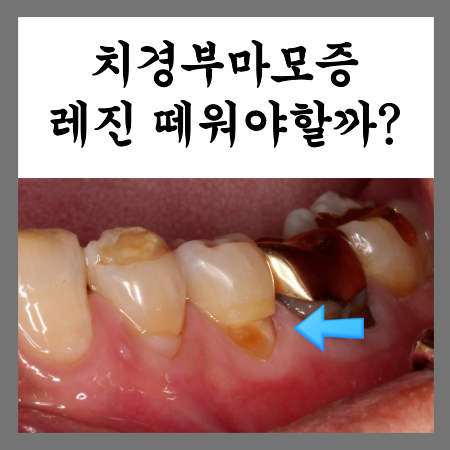  치경부 마모증, 치아패임 레진치료 전후사진(비용 포함)
