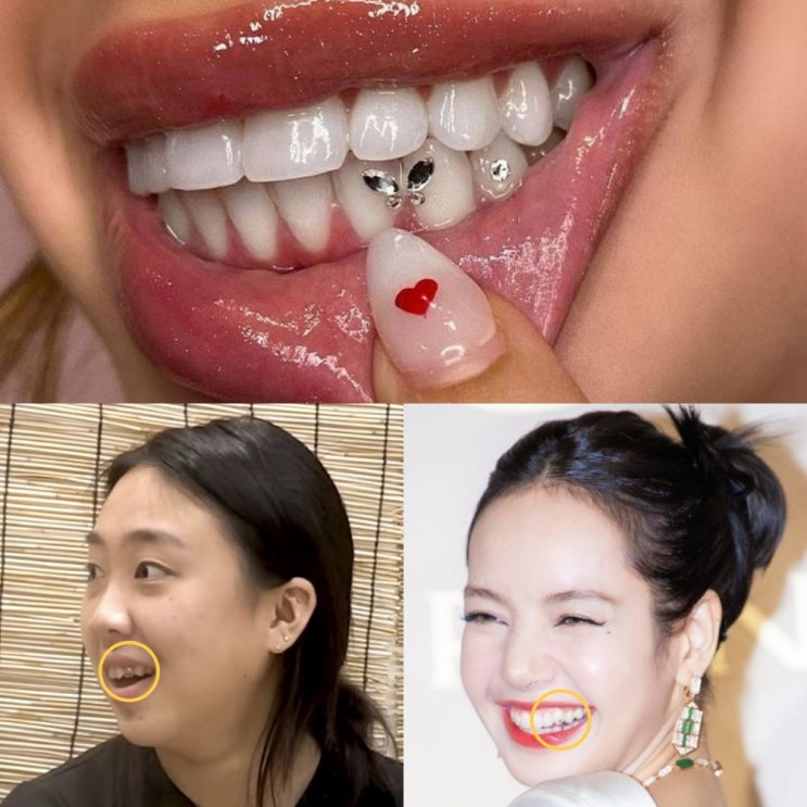  영지, 리사 투스젬 치아 보석 큐빅 투스잼 가격, 제거 및 그릴즈 차이