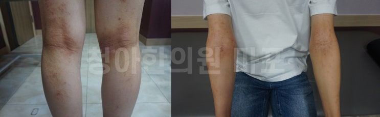  아토피 전문 병원은 동네 피부과랑 뭔가 다를까요?