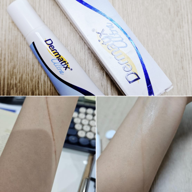 흉터연고 더마틱스 화상흉터에 한달사용 한 후기