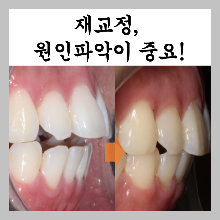  재교정, 원인파악이 중요! 개방교합과 악궁확장 후기