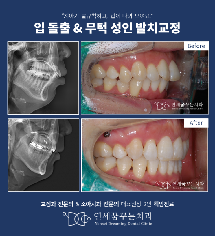 40대 여성이 작은 아래턱(무턱) 돌출과 치아 불규칙으로 발치교정을 진행한다면?