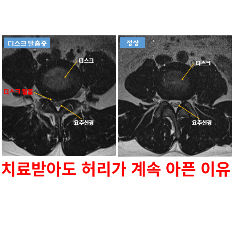  광주통증의학과, 허리 통증이 멈추지 않았던 이유