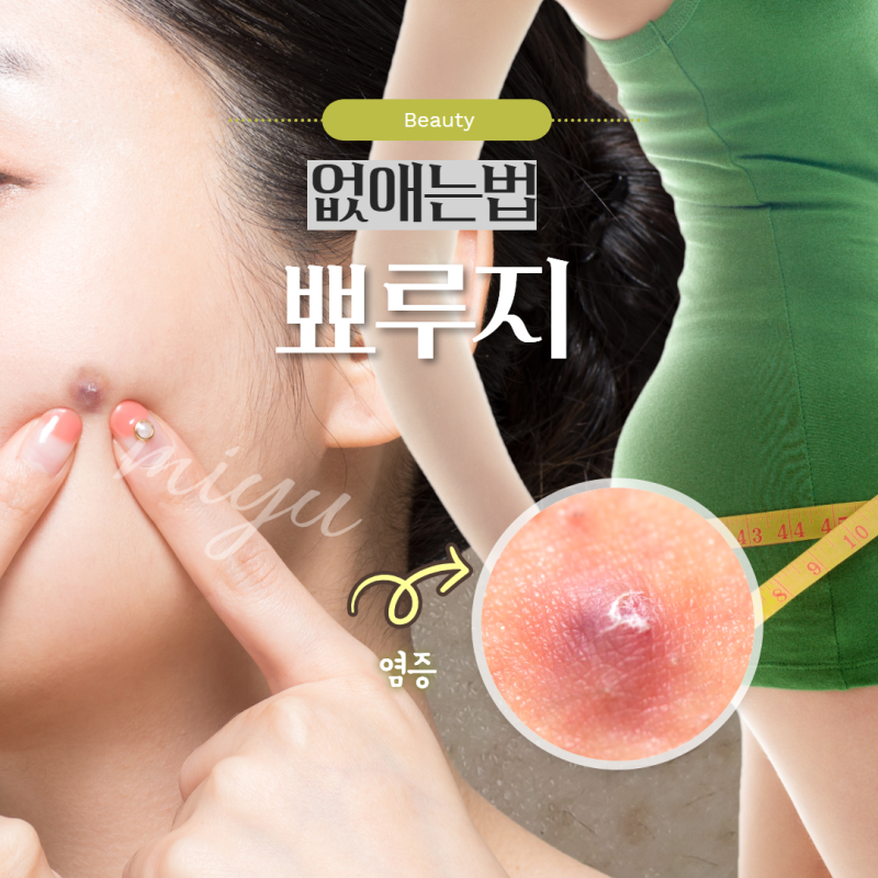 엉덩이 여드름 없애는 방법 5가지 리뷰!