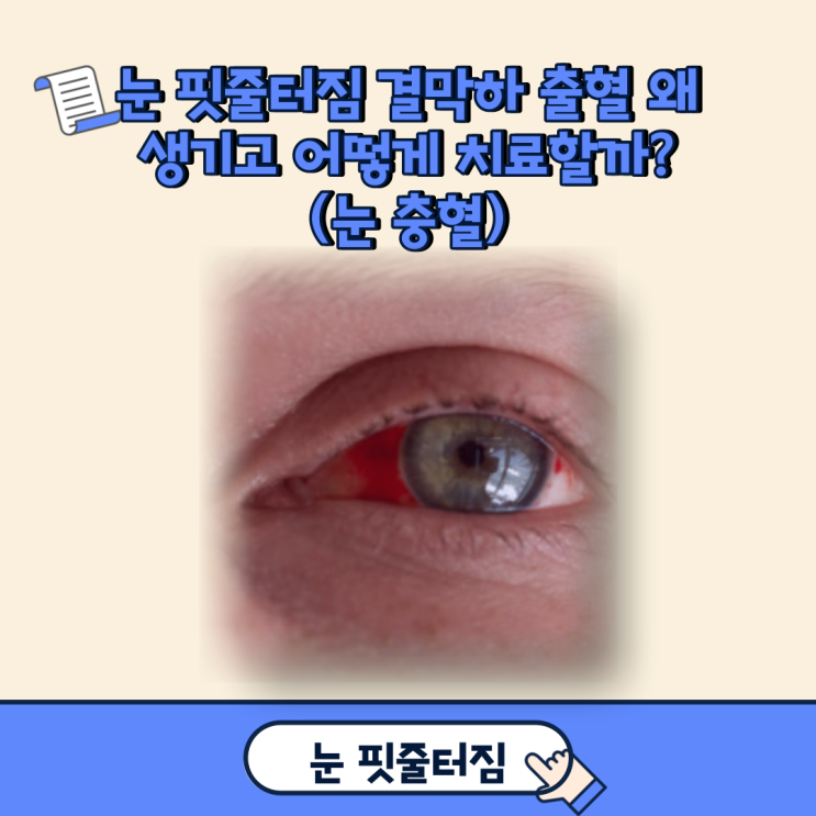 눈 핏줄터짐 결막하 출혈 왜 생기고 어떻게 치료할까?(눈 충혈)