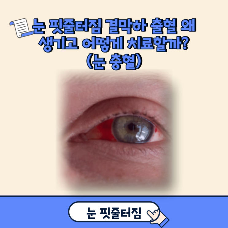  눈 핏줄터짐 결막하 출혈 왜 생기고 어떻게 치료할까?(눈 충혈)