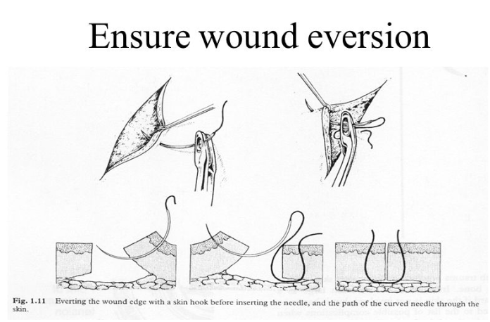 [정형외과 전문의] Skin suture, Tenorrhaphy, Arteriorrhaphy, Neurorrhaphy : 네이버 블로그